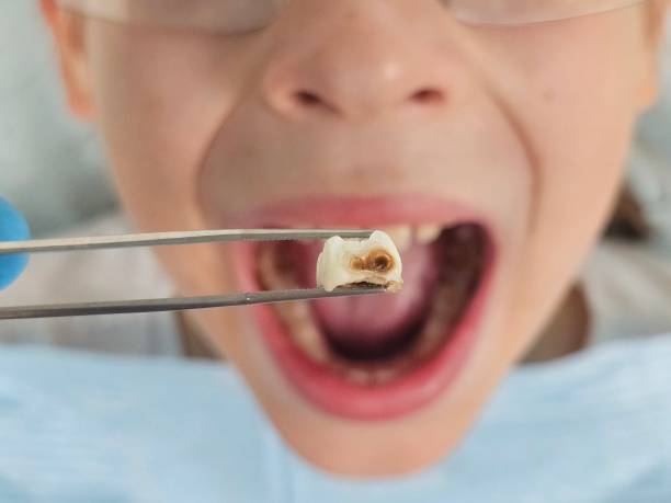 Best Urgent Care for Lost Fillings or Crowns in Northern Cambria, PA